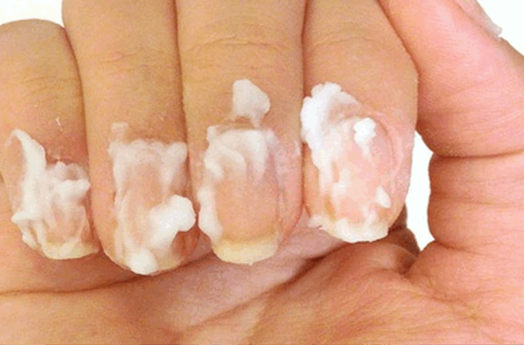 Nagelpilz vorbeugen und behandeln mit Kokosöl Nagelpflege mit Kokosöl